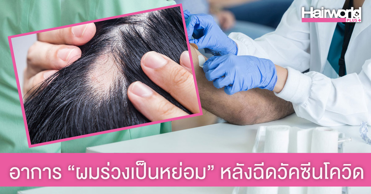 ไขข้อสงสัย อาการ “ผมร่วงเป็นหย่อม” หลังฉีดวัคซีนโควิด-19 พร้อมวิธีรักษาจากคุณหมอ